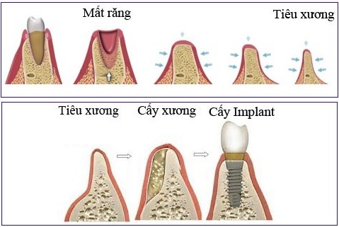 rang implant 4
