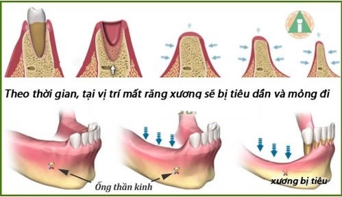 rang implant 2